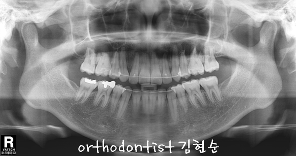 강남 돌출 관련 이미지 33