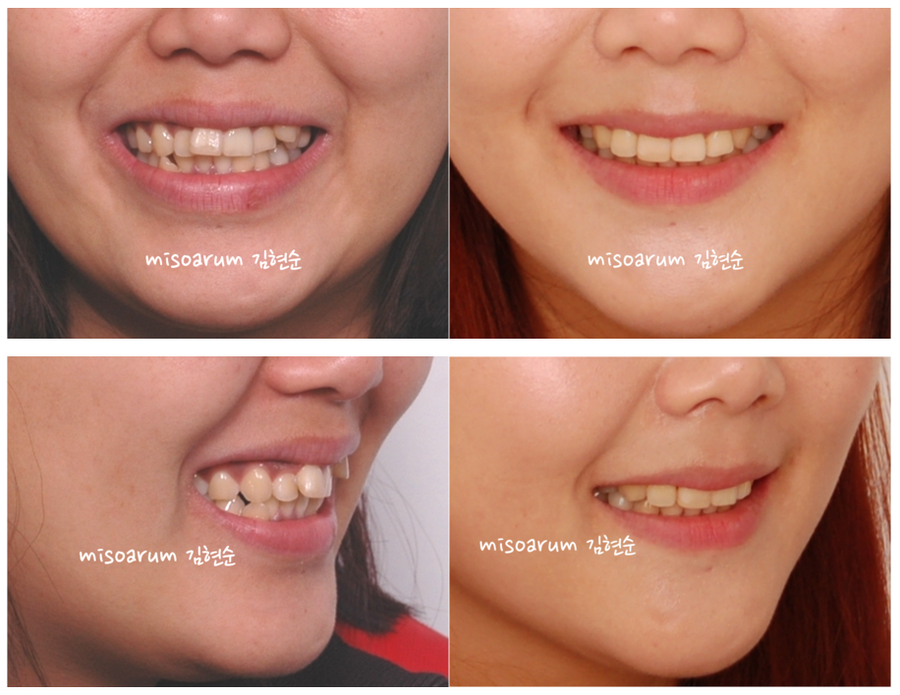 발치 교정으로 덧니 치열 올바로 잡기 관련 이미지 10