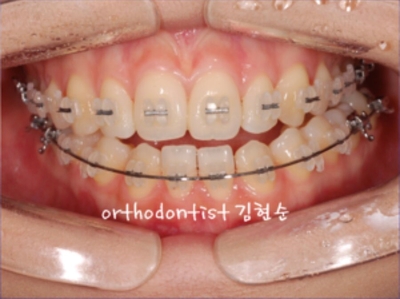 강남교정치과 관련 이미지 13