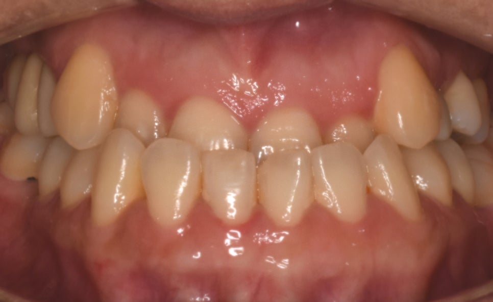 치아가 반대로 물리는 관련 이미지 3