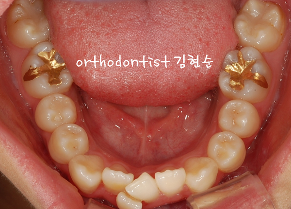 강남 덧니 관련 이미지 4