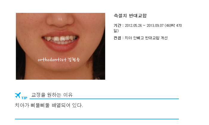 안면비대칭 교정, 치아교정만으로 간단히 해결하기 관련 이미지 4