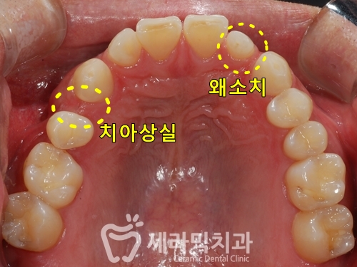 벌어진치아 투명교정 치아교정전후 관련 이미지 5