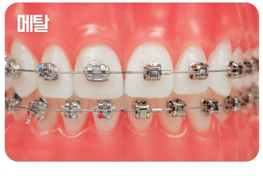 세라믹교정 클리피씨 데이몬 차이점 요약 관련 이미지 10