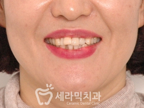 40대에 이어 50대 치아교정 전후사례 증가 추세 관련 이미지 5