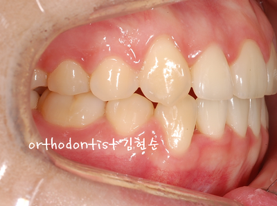 치열 교정(치열 불규칙) 관련 이미지 28