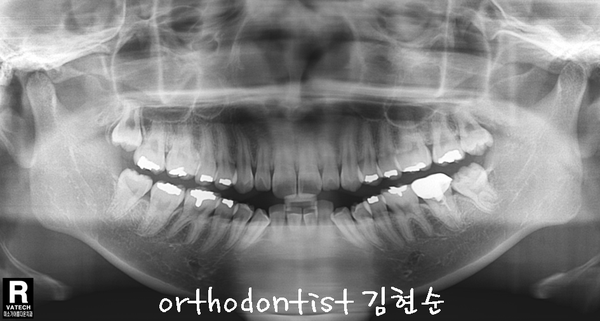 강남 돌출 관련 이미지 12