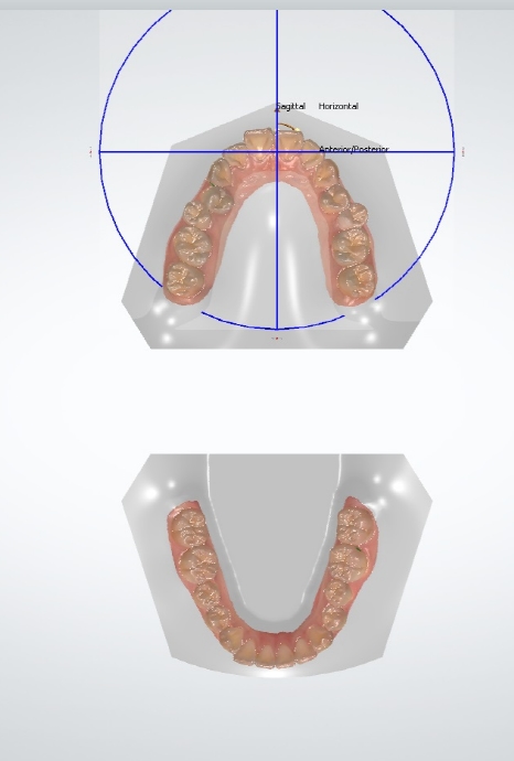 세라믹치과 수술없이 돌줄입교정 관련 이미지 4