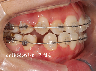 강남 덧니 관련 이미지 22