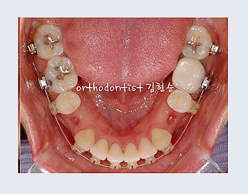 강남교정치과 관련 이미지 17