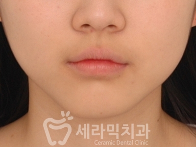 과개교합 치아교정잘하는곳, 세라믹치과 치아교정전후! 관련 이미지 6