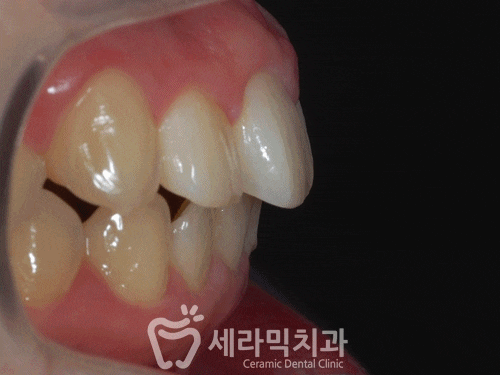 치아 재교정 치아교정전후 되찾은 밝은 미소! 관련 이미지 3
