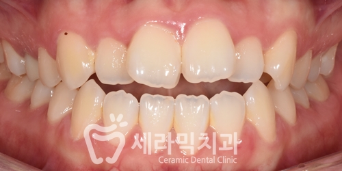 혀내밀기 습관과 개방교합, 오픈바이트(Open bite) 치아교정전후 보기 관련 이미지 1