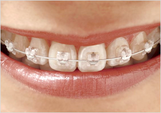 세라믹교정 세라믹치과 클리피씨교정 이야기 관련 이미지 4