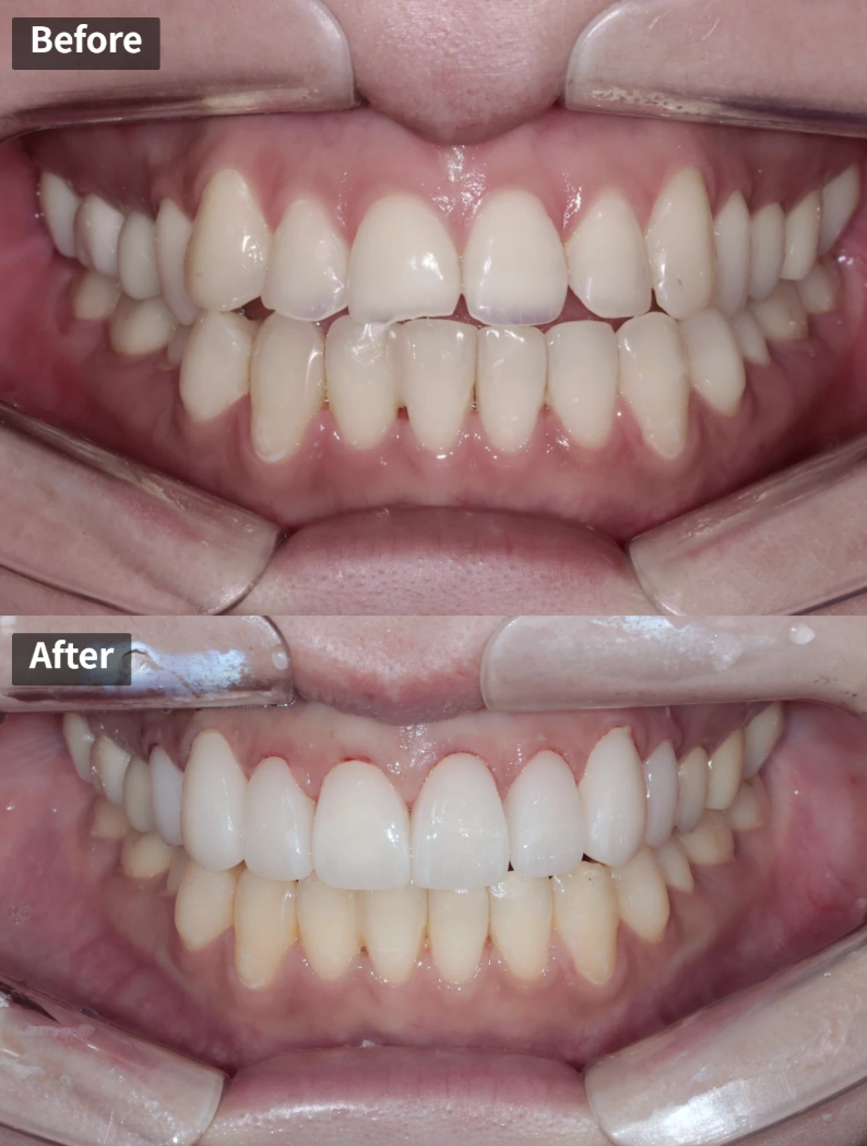 치아부식과 심미성을 동시에 잡은 앞니 치료 (ft. 역류성 식도염) 관련 이미지 1