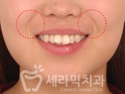 돌출입치아교정 전후사진(발치교정, 토끼이빨 인상변화) 관련 이미지 8