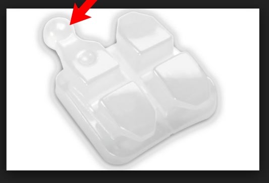 치아교정 부작용 세라믹교정 관련 이미지 6