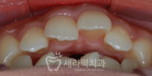 Open Bite Dental Clinic Orthodontic Before and After: Did a Long-Looking Jaw Become Shorter? image 2