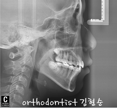 강남 덧니 관련 이미지 34