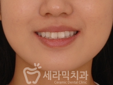 앞니 돌출, 나비치아를 남몰래 해결한 치아교정 전후! 관련 이미지 5