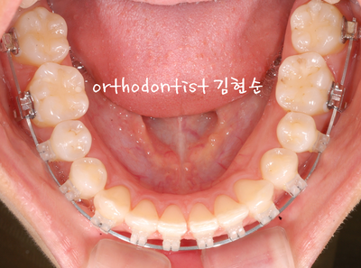돌출 교정 (비발치 교정/비대칭) 관련 이미지 23