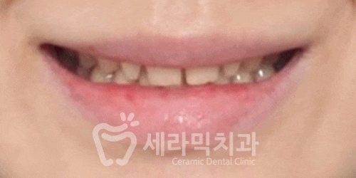 벌어진 앞니, 최소삭제 라미네이트 전후 관련 이미지 5