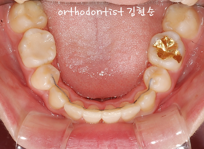 강남 돌출 (토끼 치아) 관련 이미지 28