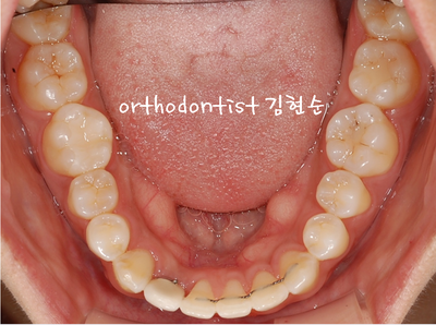 치열 교정 ( 벌어짐 ) 관련 이미지 24