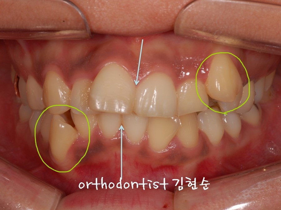 발치 교정으로 덧니 치열 올바로 잡기 관련 이미지 4