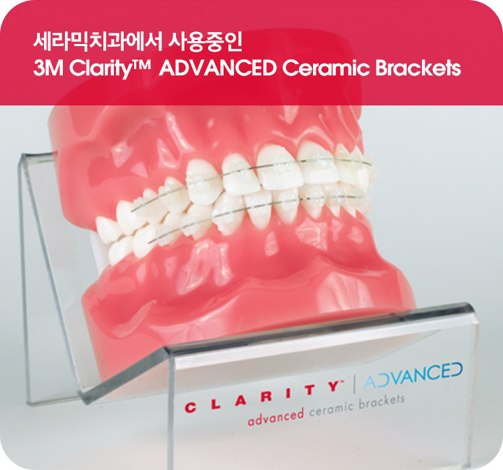 강남치아교정 브라켓비교분석 관련 이미지 1