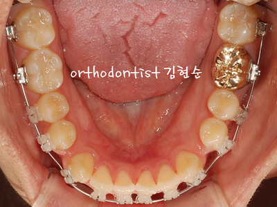 반대 교합 관련 이미지 19