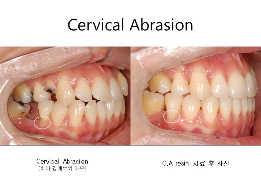 학동역치과 치아교정 잘하는 곳 ! 관련 이미지 32