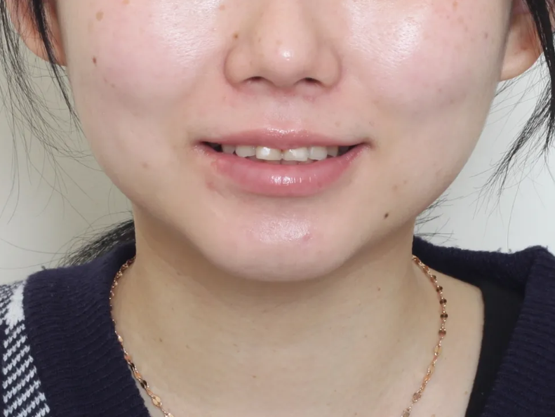 학동역 라미네이트 전후, 치아 모양과 색상 개선 사례 관련 이미지 3