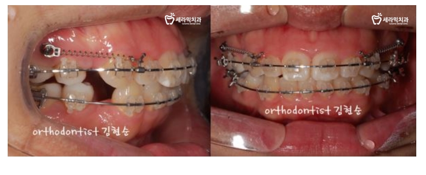 돌출입 교정으로 외모변화를 확인 관련 이미지 9