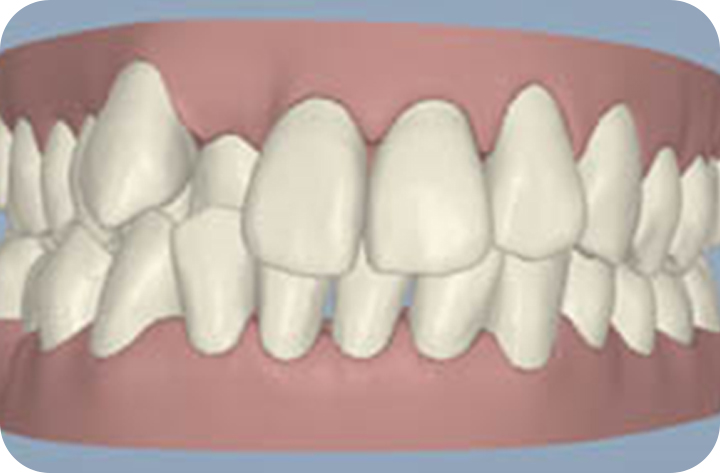 강남치아교정 브라켓비교분석 관련 이미지 9