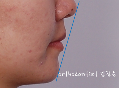 강남 돌출 관련 이미지 27