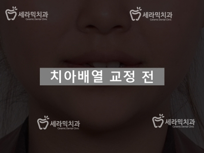 토끼이빨, 틀어진 치아배열 세라믹교정 전후사진 관련 이미지 1