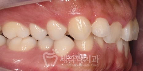 A Case of Overretained Teeth and Deep Bite Orthodontics That Helped the Patient Smile Confidently Before and After image 5