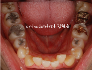 강남 돌출입 교정 관련 이미지 10
