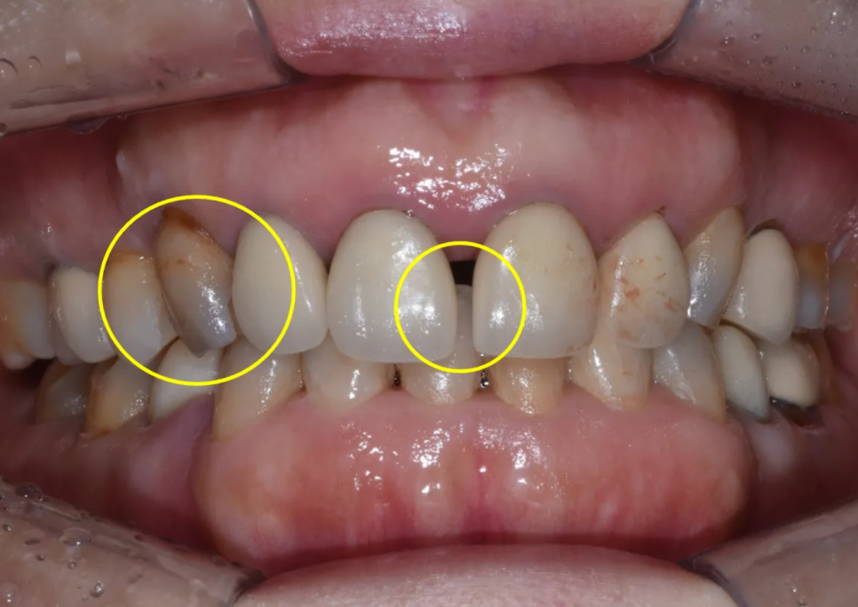 일본에서 거절당했던 앞니 심미보철 크라운 관련 이미지 4