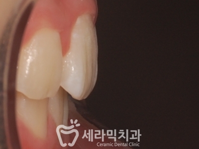 토끼이빨 돌출입 치아교정 전후 표정변화! 관련 이미지 19