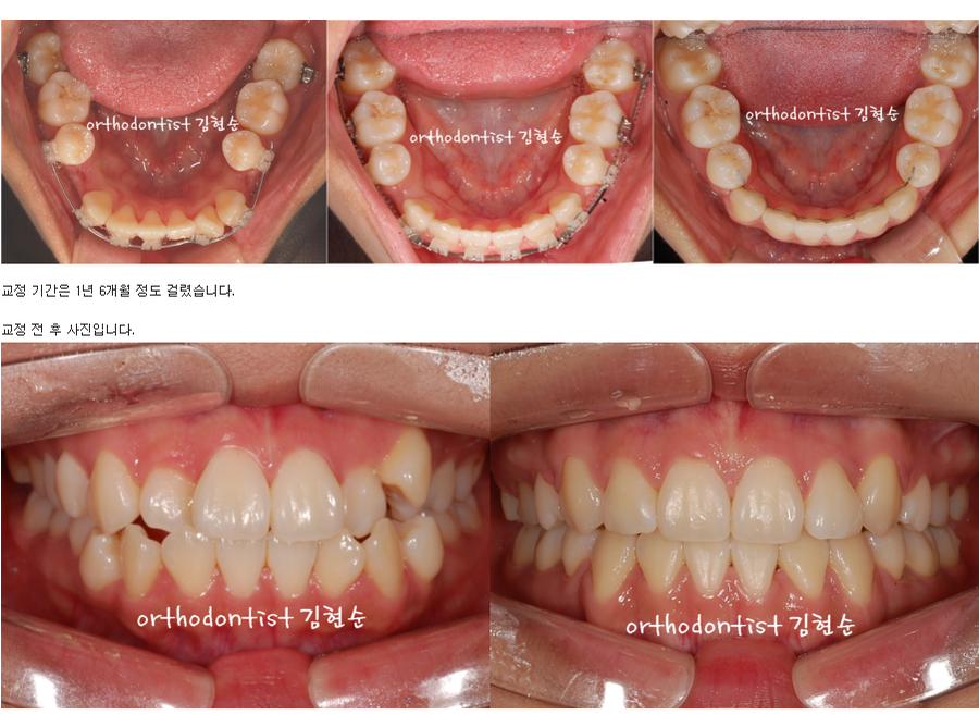 세라믹교정 세라믹치과-돌출입발치교정 4 관련 이미지 4