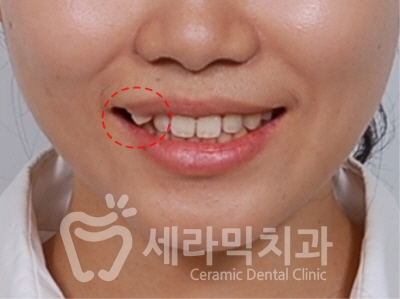 비발치 덧니교정으로 자신감 UP! 치아건강도 UP! 관련 이미지 2