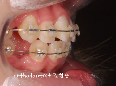 강남 돌출 (토끼 치아) 관련 이미지 19