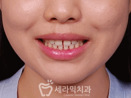 치아교정전후 : 치아사이틈, 벌어진 공간 치아교정으로 치료! 관련 이미지 4