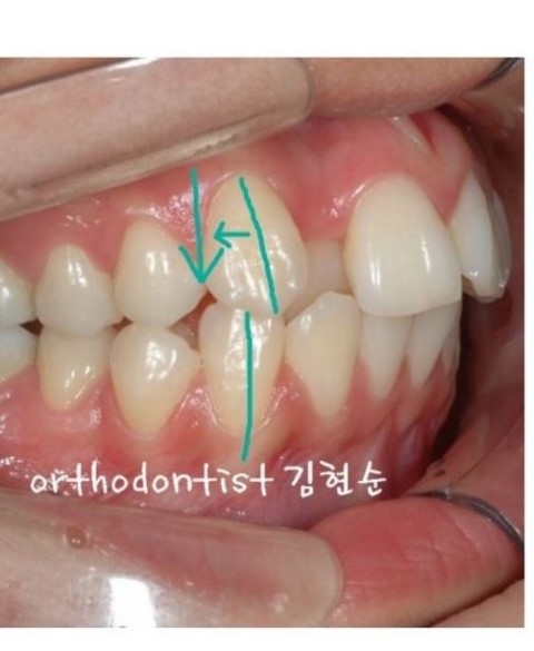 세라믹교정 가격 4대부작용 관련 이미지 4