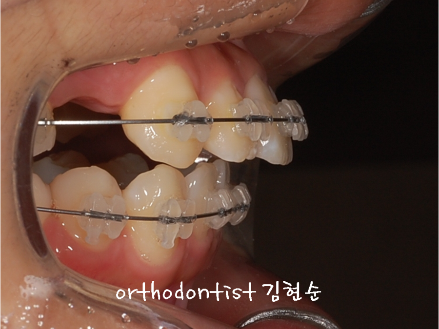 세라믹교정 은 세라믹치과 발치비발치 해결 관련 이미지 6