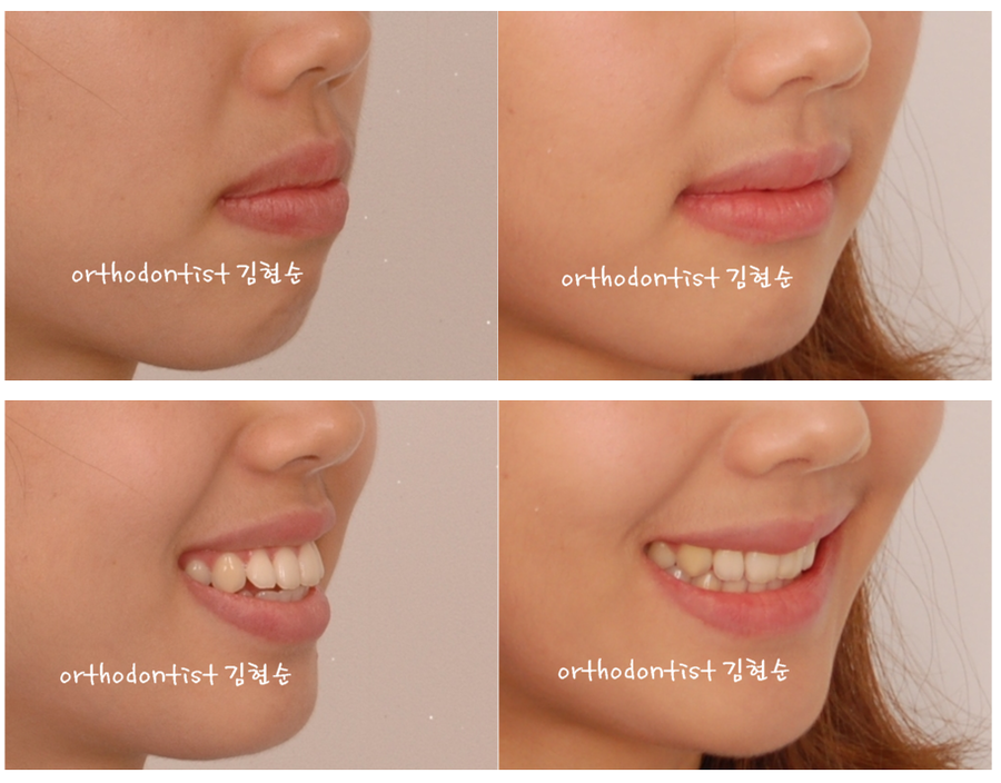 세라믹교정 세라믹치과-돌출입발치교정 6 관련 이미지 7