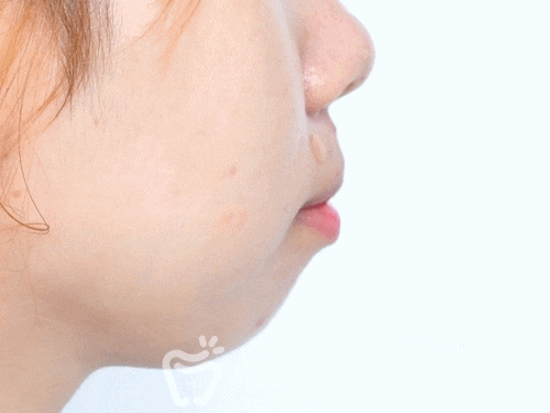 벌어진 돌출입 치아교정으로 빈틈없이 깔끔하게! 관련 이미지 3