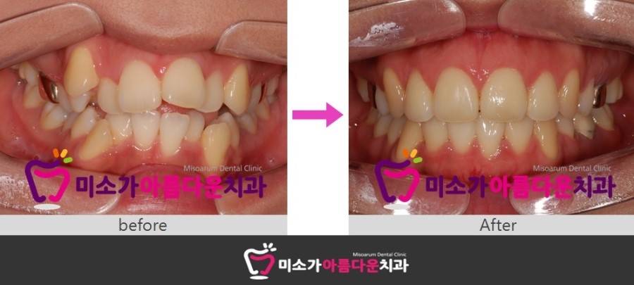 세라믹교정 덧니교정 세라믹치과에서 ~~ 관련 이미지 4